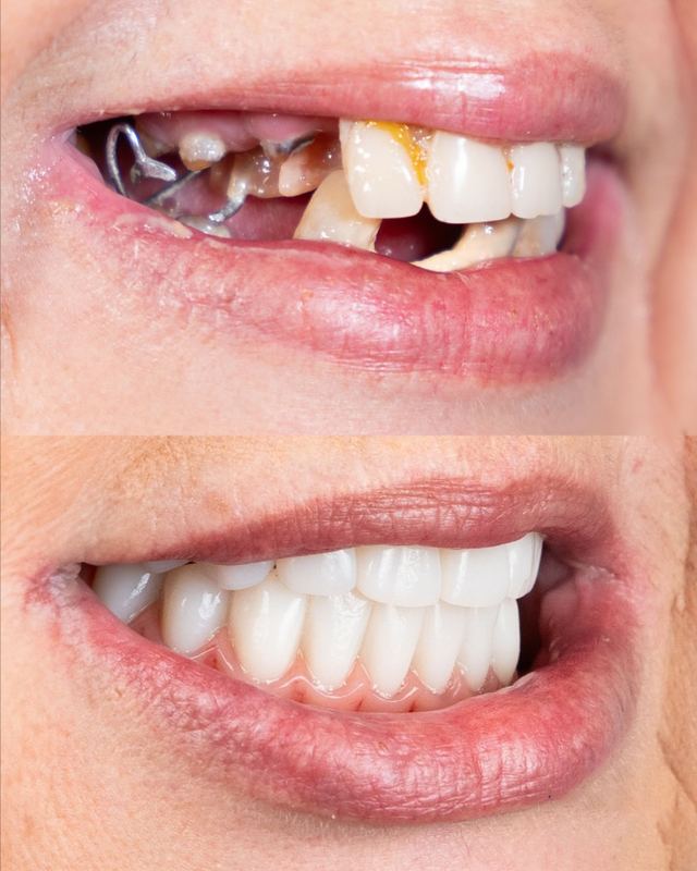 Prima e dopo di un trattamento ad A1 Dental Tirana