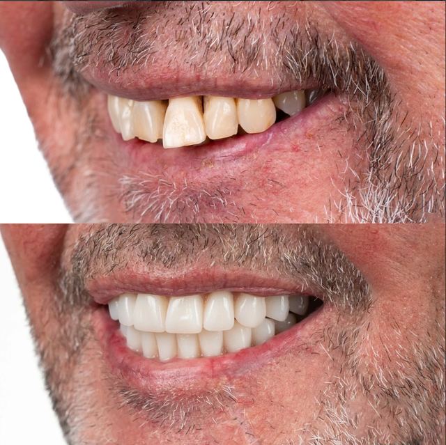 Prima e dopo di una cura dentale ad A1 Dental Tirana