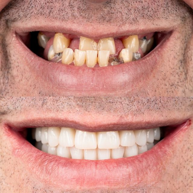 Prima e dopo di un trattamento estetico ad A1 Dental Tirana