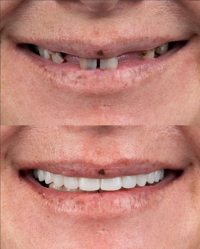 Prima e dopo sui denti anteriori ad A1 Dental Tirana