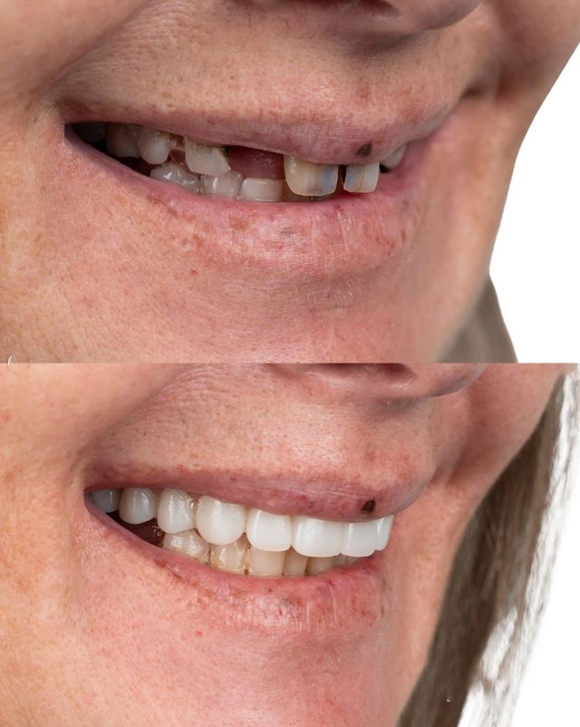 Risultato estetico prima e dopo ad A1 Dental Tirana