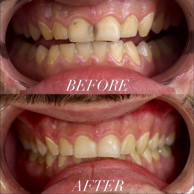Prima e dopo di una riabilitazione ad A1 Dental Tirana