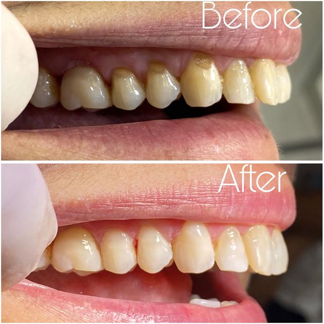 Prima e dopo di un restauro ad A1 Dental Tirana