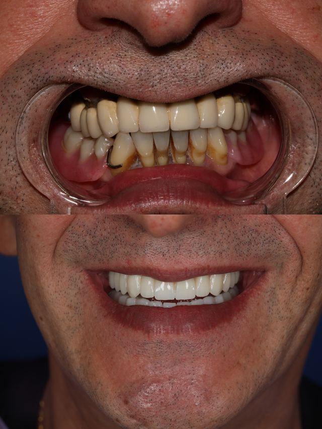 Riabilitazione completa, prima e dopo ad A1 Dental Tirana