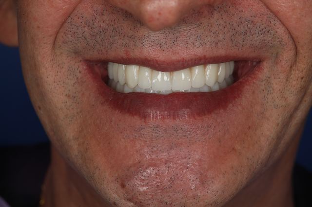 Sorriso dopo la riabilitazione protesica ad A1 Dental Tirana